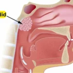 adenoidid